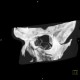 Comminuted fracture of facial skeleton: CT - Computed tomography